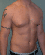 Gynecomastia Surgery for Bodybuilders