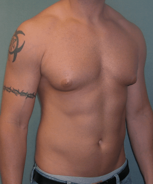 Gynecomastia Surgery for Bodybuilders
