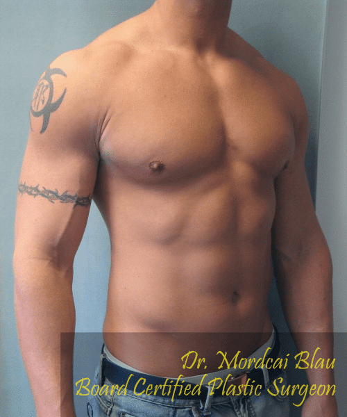 Gynecomastia Surgery for Bodybuilders