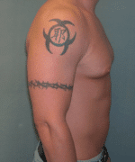 Gynecomastia Surgery for Bodybuilders