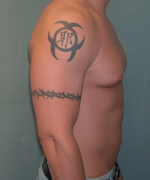 Gynecomastia Surgery for Bodybuilders