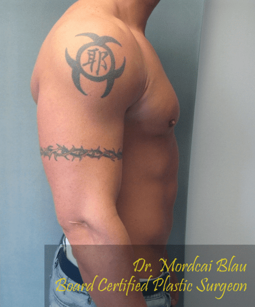 Gynecomastia Surgery for Bodybuilders