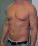 Gynecomastia Surgery for Bodybuilders