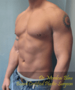 Gynecomastia Surgery for Bodybuilders