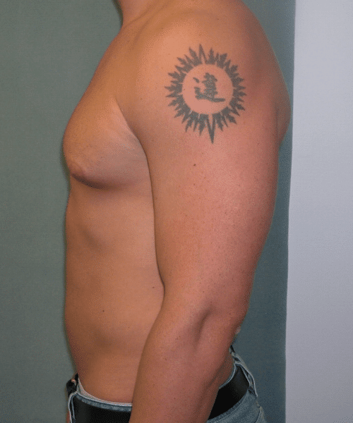 Gynecomastia Surgery for Bodybuilders