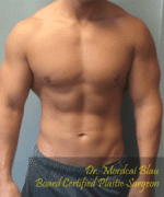 Gynecomastia Surgery for Bodybuilders