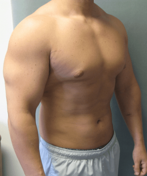 Gynecomastia Surgery for Bodybuilders