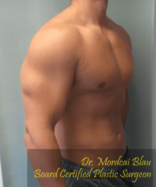 Gynecomastia Surgery for Bodybuilders