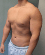 Gynecomastia Surgery for Bodybuilders