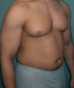 Gynecomastia Surgery for Bodybuilders