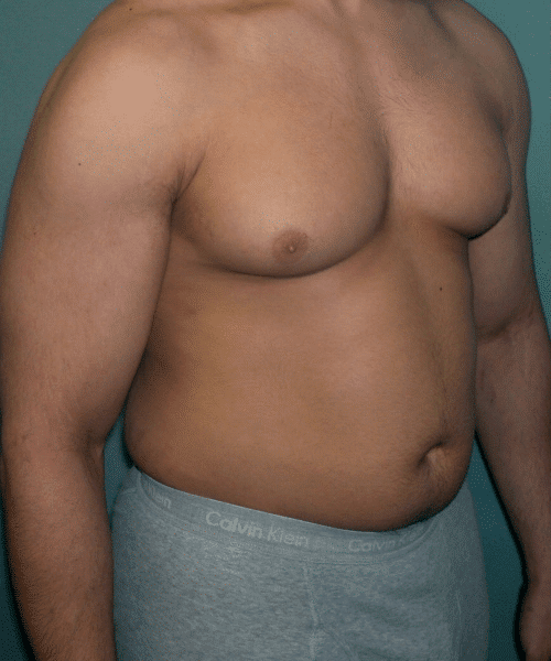 Gynecomastia Surgery for Bodybuilders
