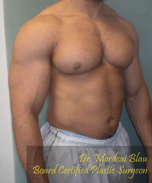 Gynecomastia Surgery for Bodybuilders