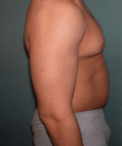 Gynecomastia Surgery for Bodybuilders