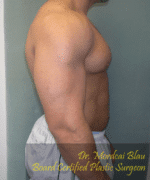 Gynecomastia Surgery for Bodybuilders