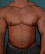 Gynecomastia Surgery for Bodybuilders