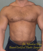 Gynecomastia Surgery for Bodybuilders