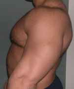 Gynecomastia Surgery for Bodybuilders