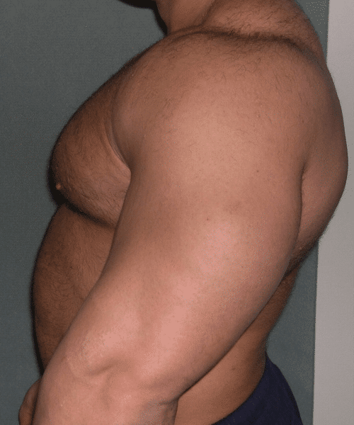 Gynecomastia Surgery for Bodybuilders