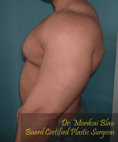 Gynecomastia Surgery for Bodybuilders