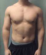 Gynecomastia Surgery for Bodybuilders