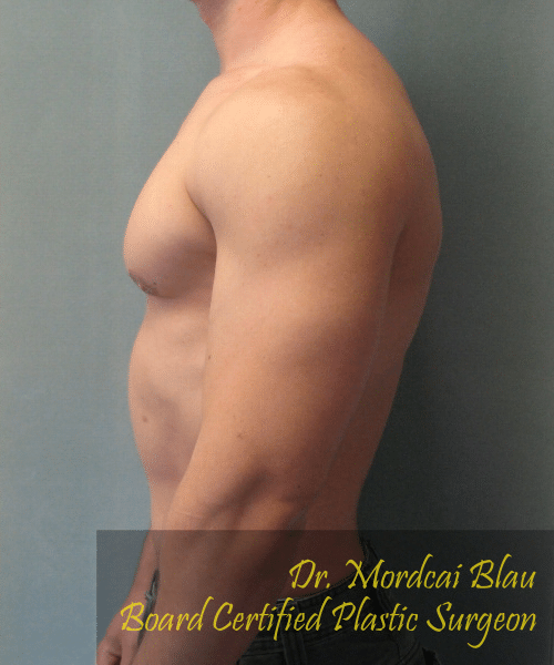 Gynecomastia Surgery for Bodybuilders