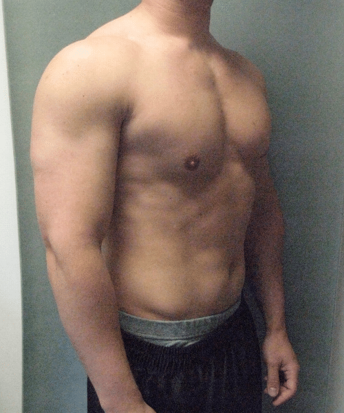 Gynecomastia Surgery for Bodybuilders