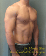 Gynecomastia Surgery for Bodybuilders