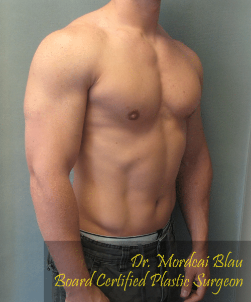 Gynecomastia Surgery for Bodybuilders