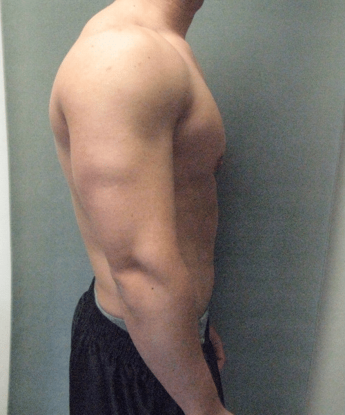 Gynecomastia Surgery for Bodybuilders