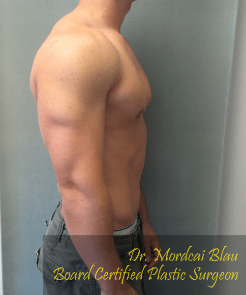 Gynecomastia Surgery for Bodybuilders