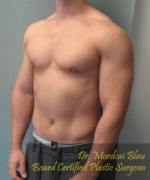 Gynecomastia Surgery for Bodybuilders