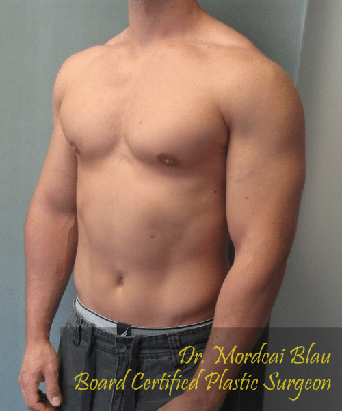 Gynecomastia Surgery for Bodybuilders