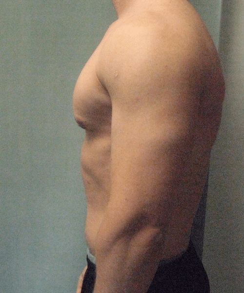 Gynecomastia Surgery for Bodybuilders