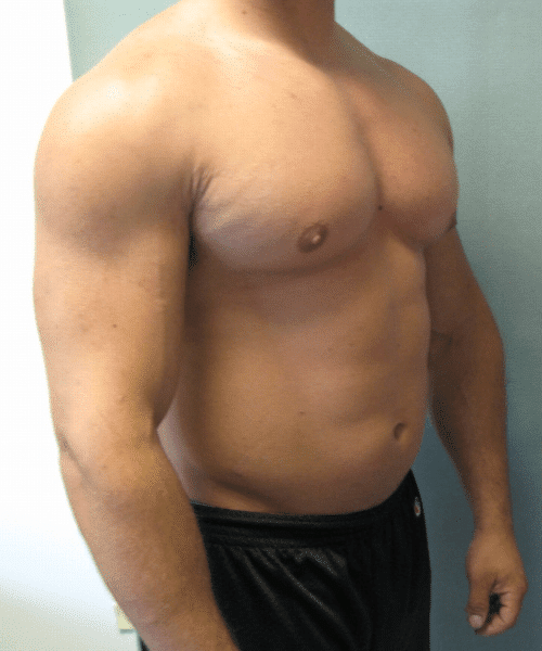 Gynecomastia Surgery for Bodybuilders