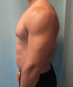 Gynecomastia Surgery for Bodybuilders