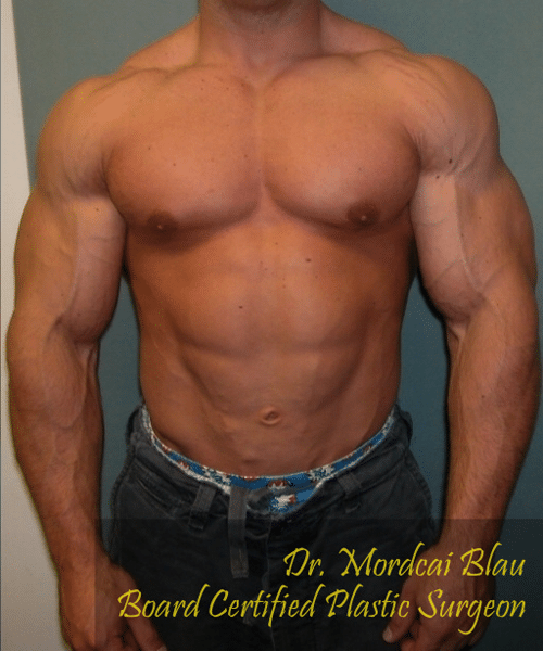 Bodybuilders After Photo Bodybuilders