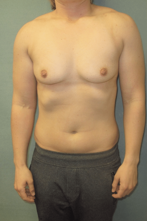 gynecomastia