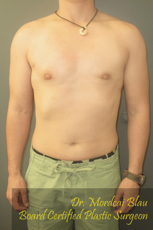 male breast reduction