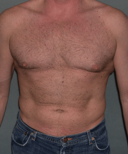 Adults (20-40) Before Photo Adults (20-40)
