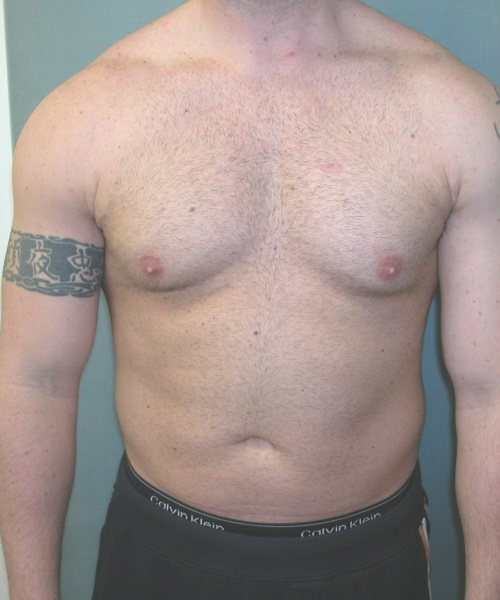 Adults (20-40) Before Photo Adults (20-40)