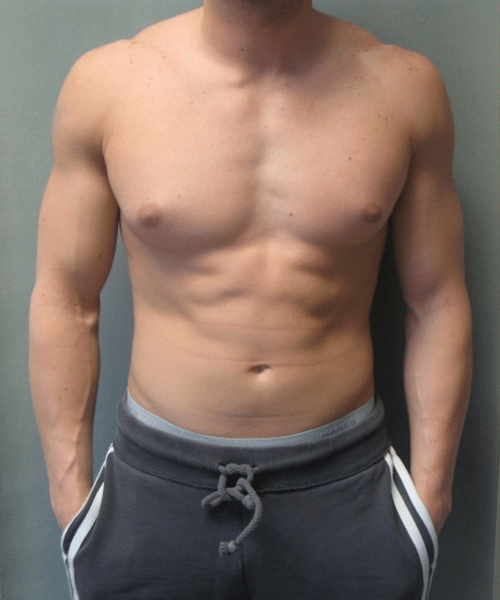 Adults (20-40) Before Photo Adults (20-40)
