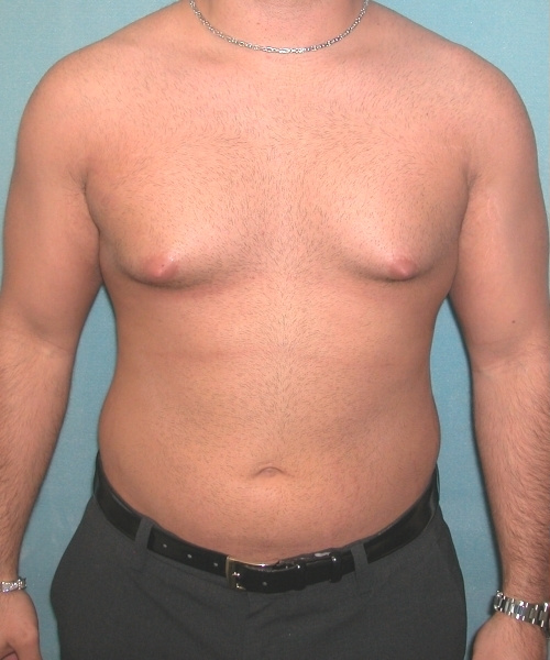 Adults (20-40) Before Photo Adults (20-40)
