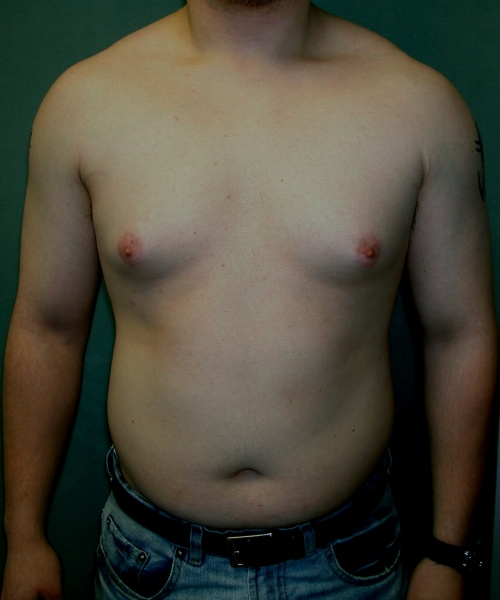 Adults (20-40) Before Photo Adults (20-40)