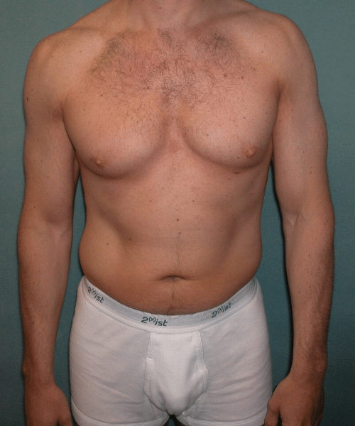 Adults (20-40) Before Photo Adults (20-40)