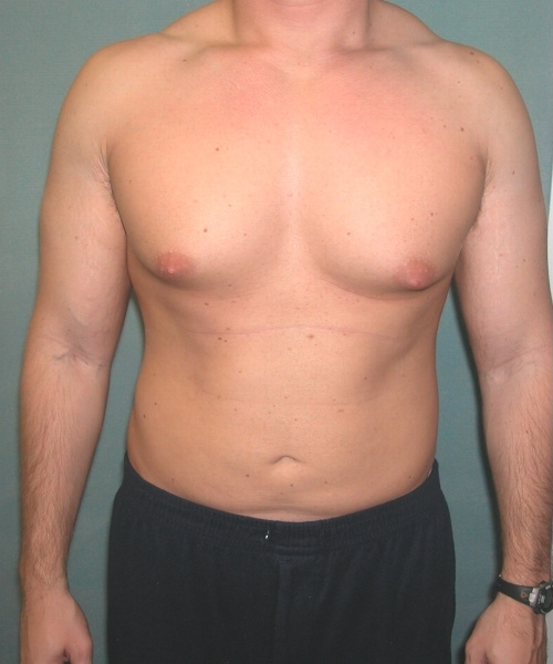 Adults (20-40) Before Photo Adults (20-40)