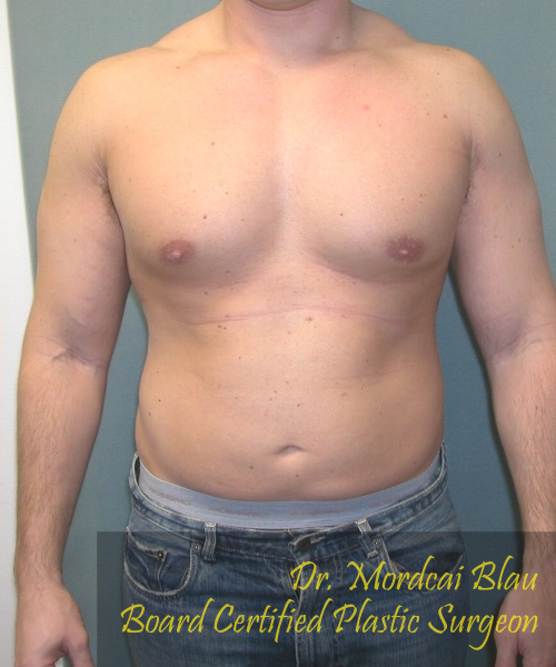 Adults (20-40) After Photo Adults (20-40)