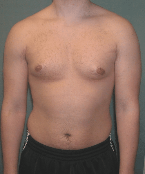 Adults (20-40) Before Photo Adults (20-40)