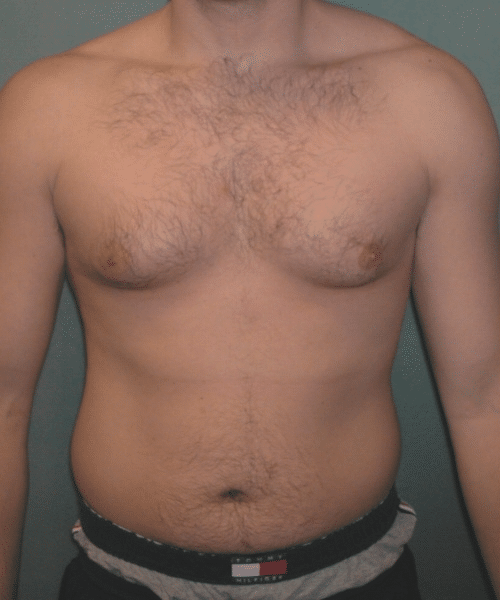 Adults (20-40) Before Photo Adults (20-40)