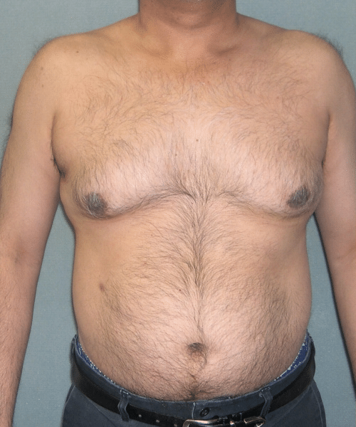 Adults (20-40) Before Photo Adults (20-40)