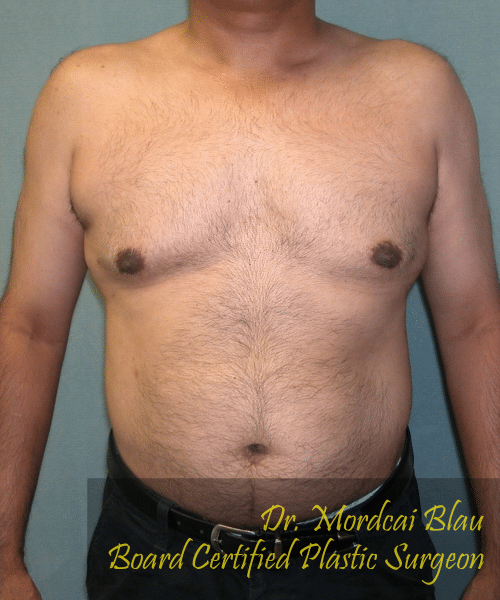 Adults (20-40) After Photo Adults (20-40)